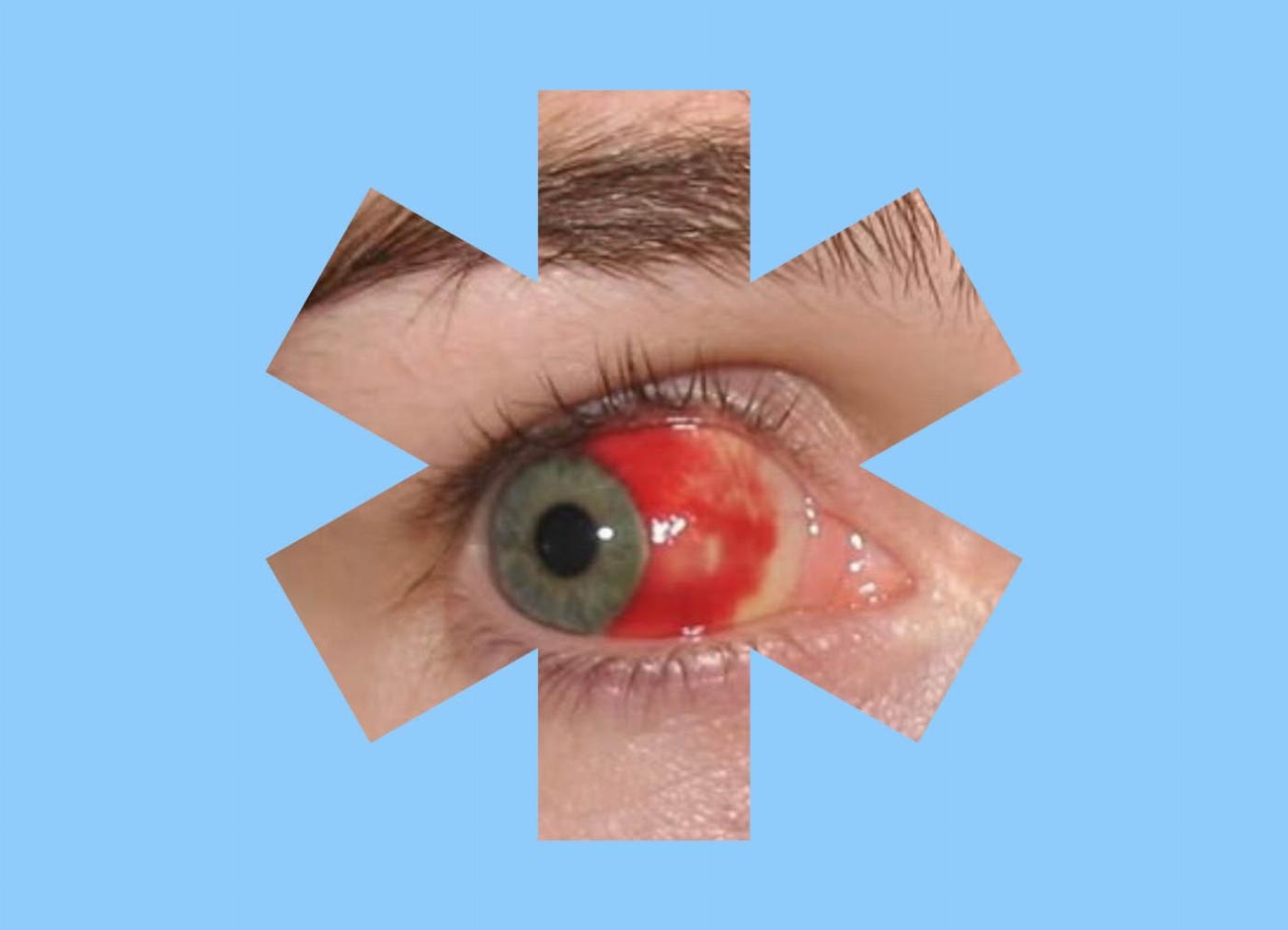 Voorbeeld van een oogziekte in de vorm van De Vragendokter huisstijl Voorbeeld van een oogziekte in de vorm van De Vragendokter huisstijl